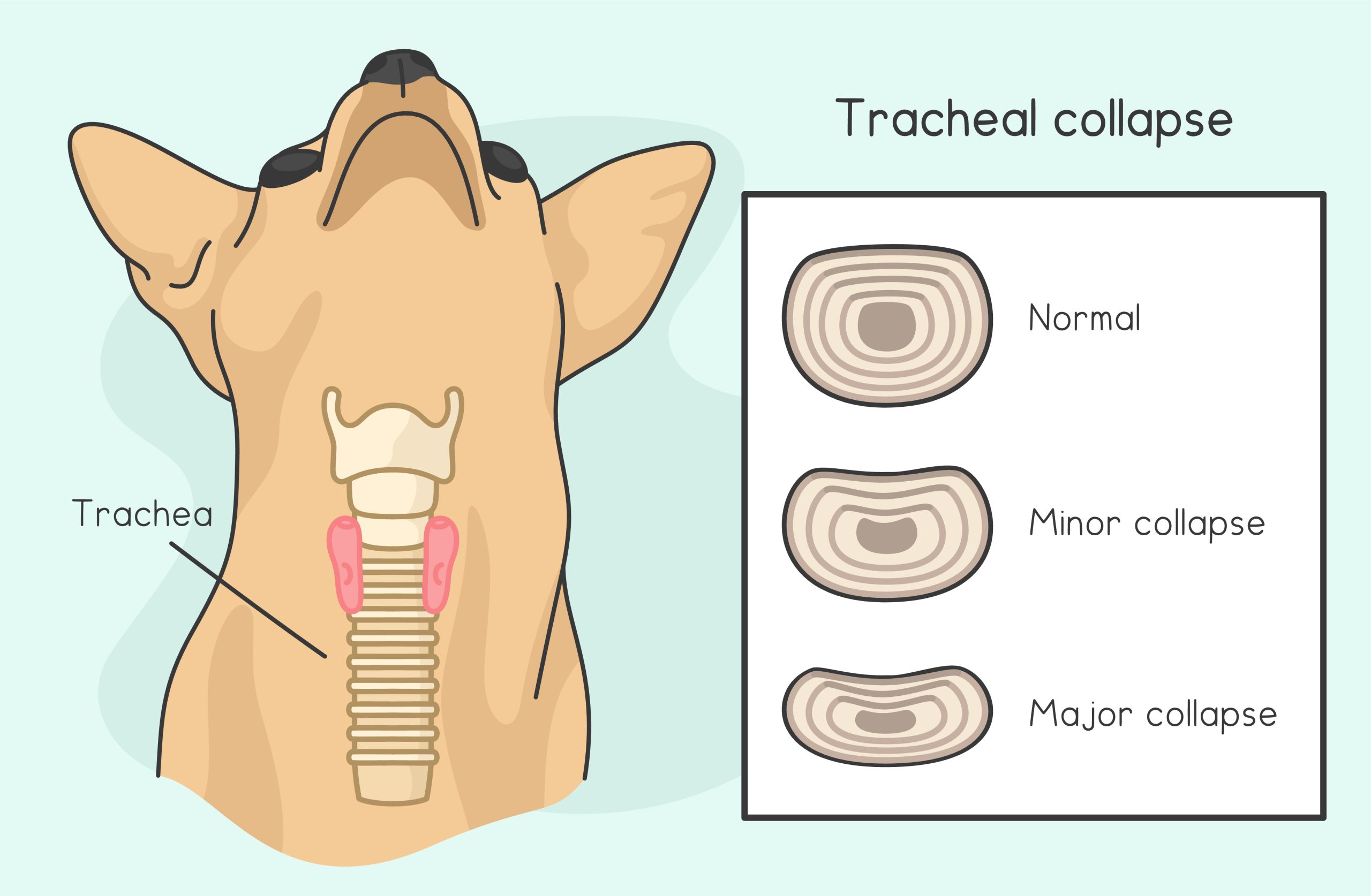 Tracheal_collapse